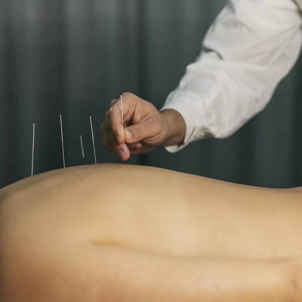 acupuncture-process