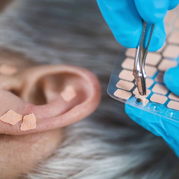 Auriculotherapy, or auricular treatment on human ear, close up. Therapist hand applying acupuncture ear seed sticker with tweezers.